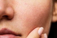 লোমকূপ-বন্ধ-করার-প্রাকৃতিক-উপায়