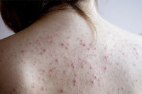 ঘেমে-গেলেই-পিঠ-জুড়ে-ব্রণ-হয়,-পুজোর-আগেই-সারিয়ে-ফেলুন