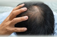 টাকে-চুল-গজানো-কোনও-ব্যাপারই-না
