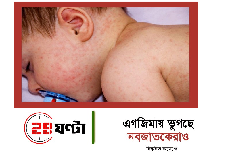 এগজিমায় ভুগছে নবজাতকেরাও